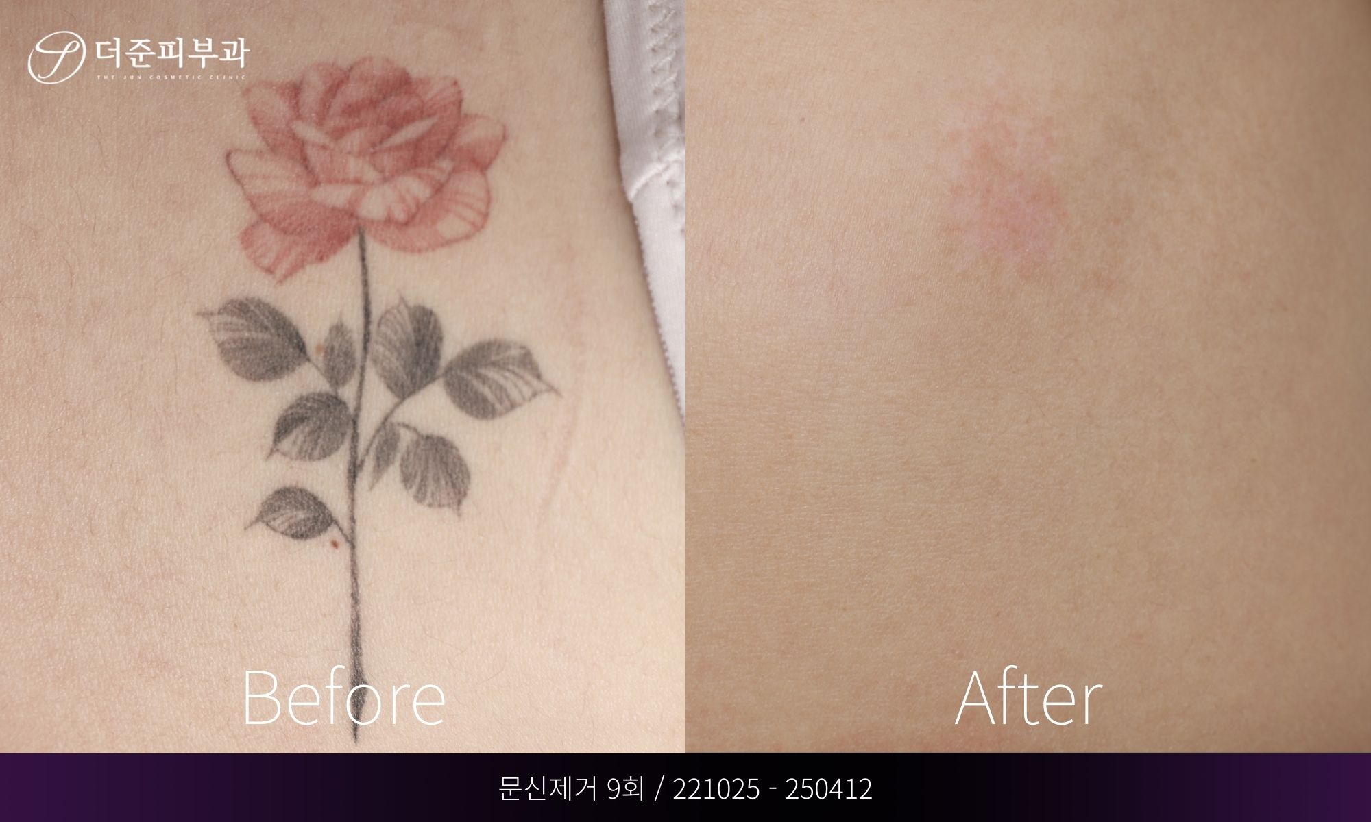 문신제거 (7)